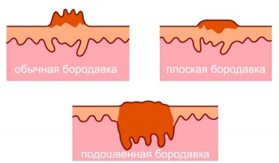 Как выглядят бородавки в разрезе Как выглядят бородавки в разрезе