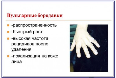 Что такое вульгарные бородавки Что такое вульгарные бородавки